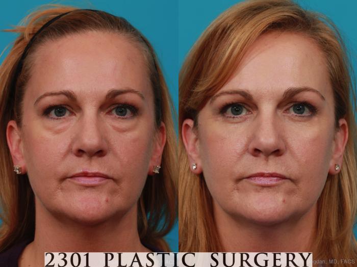 Before & After Blepharoplasty Case 270 View #1 View in Fort Worth, Plano, & Frisco, Texas