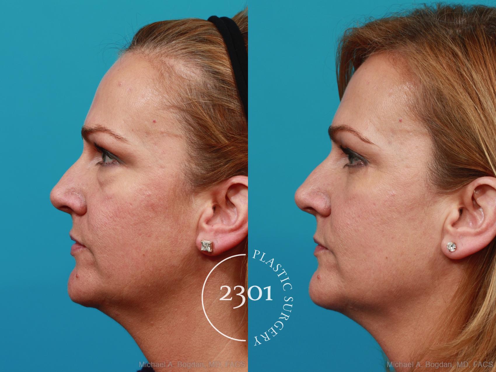 Before & After Blepharoplasty Case 270 View #2 View in Fort Worth, Plano, & Frisco, Texas