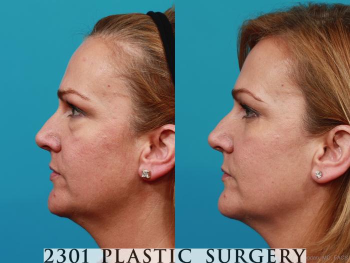 Before & After Blepharoplasty Case 270 View #2 View in Fort Worth, Plano, & Frisco, Texas