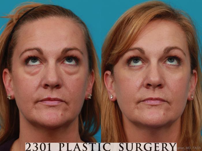 Before & After Blepharoplasty Case 270 View #3 View in Fort Worth, Plano, & Frisco, Texas