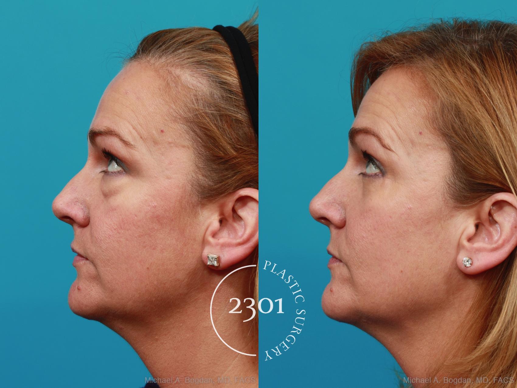 Before & After Blepharoplasty Case 270 View #4 View in Fort Worth, Plano, & Frisco, Texas