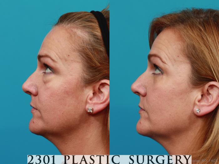Before & After Blepharoplasty Case 270 View #4 View in Fort Worth, Plano, & Frisco, Texas