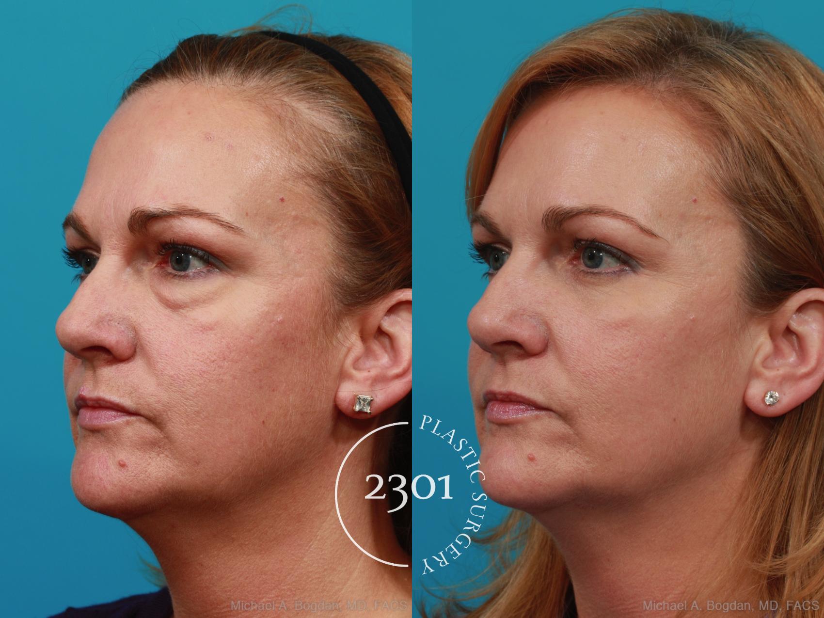 Before & After Blepharoplasty Case 270 View #5 View in Fort Worth, Plano, & Frisco, Texas
