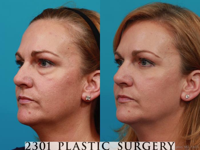 Before & After Blepharoplasty Case 270 View #5 View in Fort Worth, Plano, & Frisco, Texas