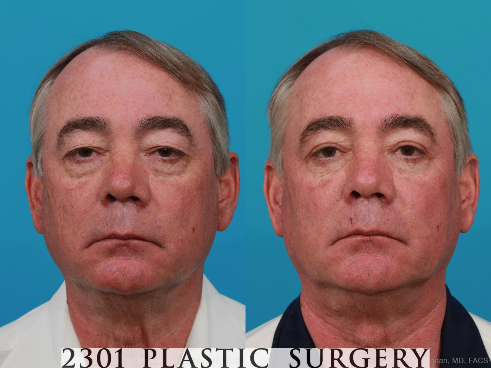 Before & After Male Eyelid Surgery Case 274 View #1 View in Fort Worth, Plano, & Frisco, Texas