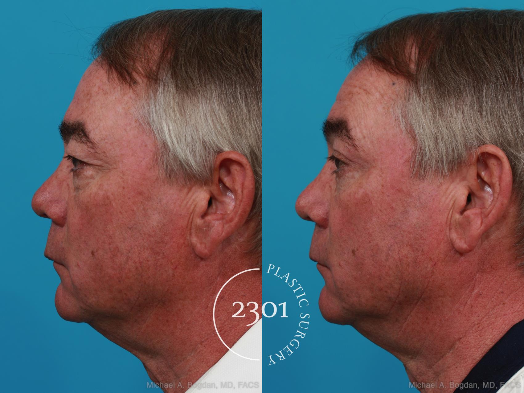 Before & After Blepharoplasty Case 274 View #2 View in Fort Worth, Plano, & Frisco, Texas