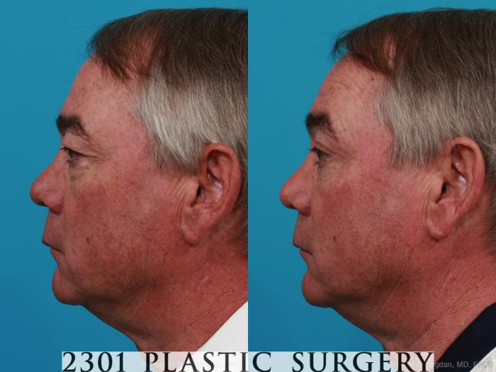 Before & After Male Eyelid Surgery Case 274 View #2 View in Fort Worth, Plano, & Frisco, Texas