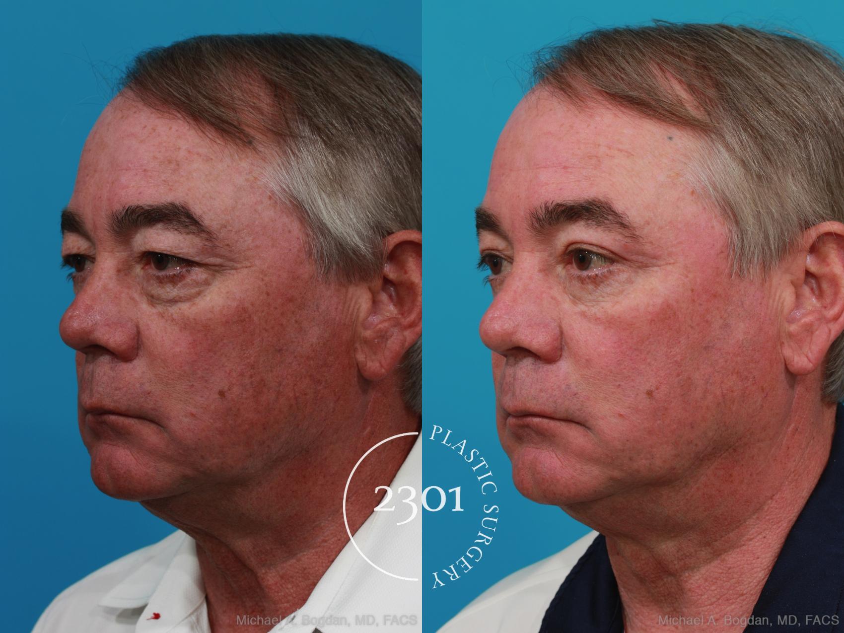 Before & After Blepharoplasty Case 274 View #3 View in Fort Worth, Plano, & Frisco, Texas