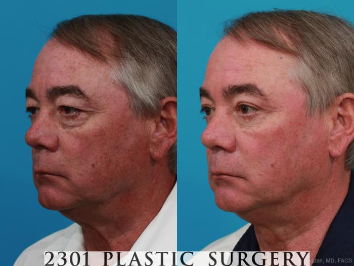 Before & After Male Eyelid Surgery Case 274 View #3 View in Fort Worth, Plano, & Frisco, Texas