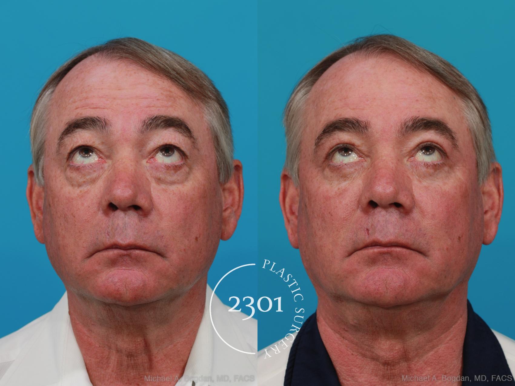 Before & After Blepharoplasty Case 274 View #4 View in Fort Worth, Plano, & Frisco, Texas