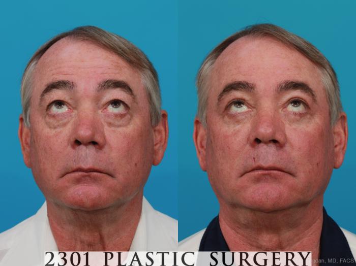 Before & After Male Eyelid Surgery Case 274 View #4 View in Fort Worth, Plano, & Frisco, Texas