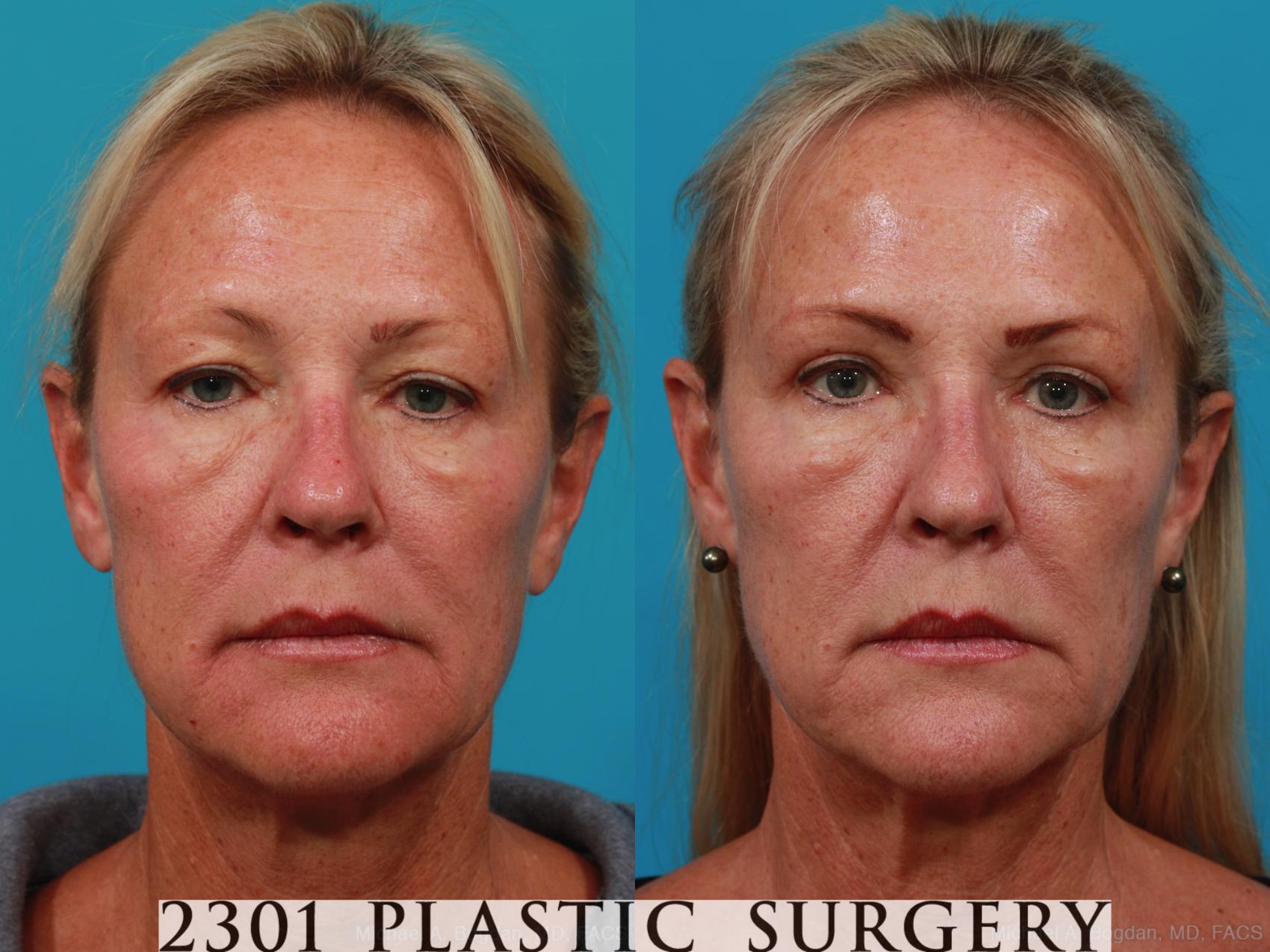 Before & After Blepharoplasty Case 290 View #1 View in Fort Worth, Plano, & Frisco, Texas