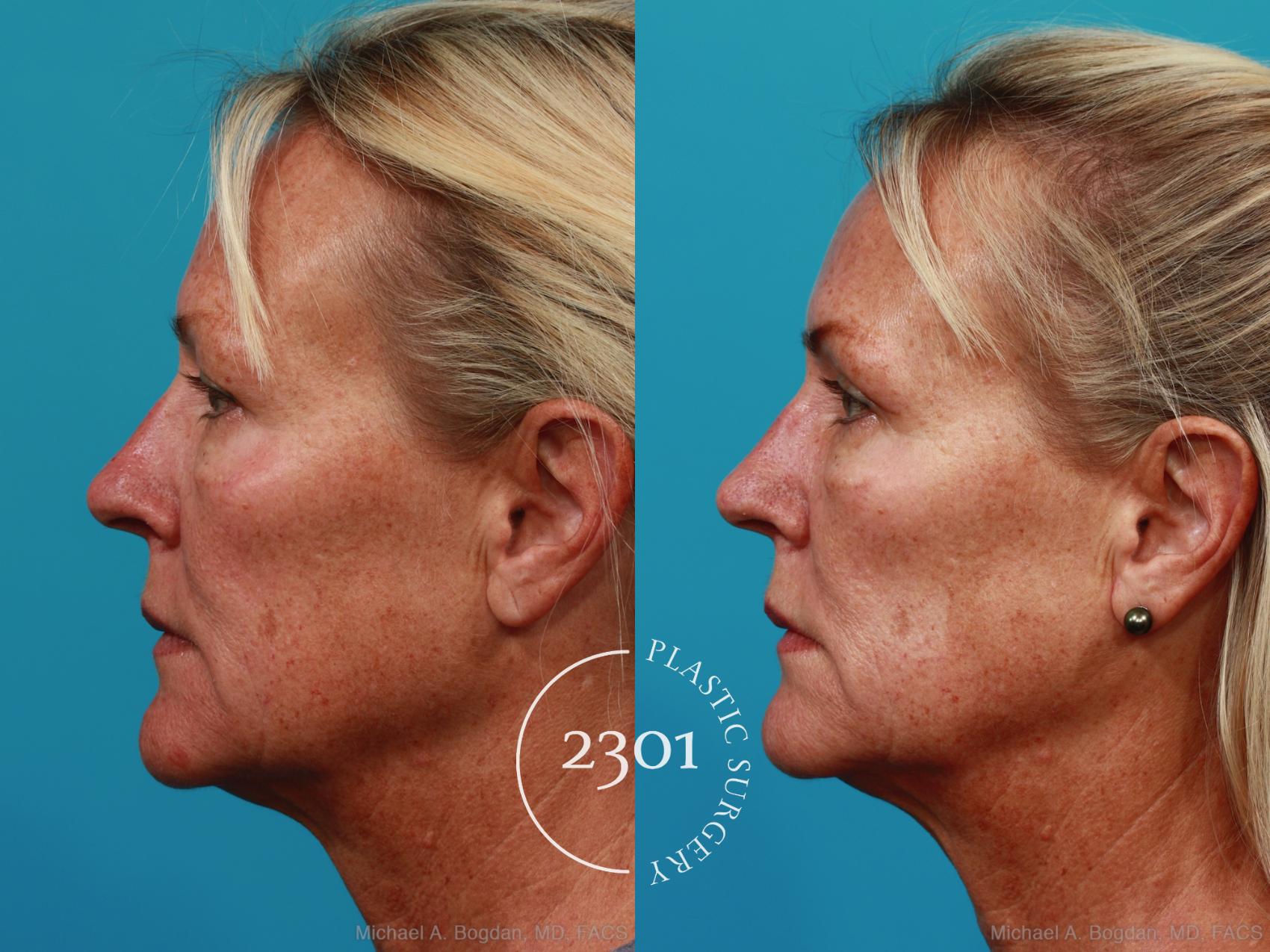 Before & After Blepharoplasty Case 290 View #2 View in Fort Worth, Plano, & Frisco, Texas