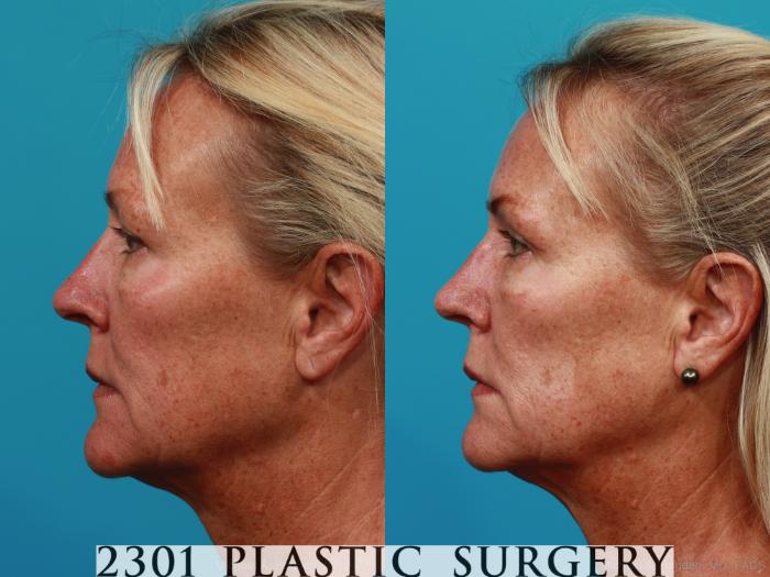 Before & After Blepharoplasty Case 290 View #2 View in Fort Worth, Plano, & Frisco, Texas