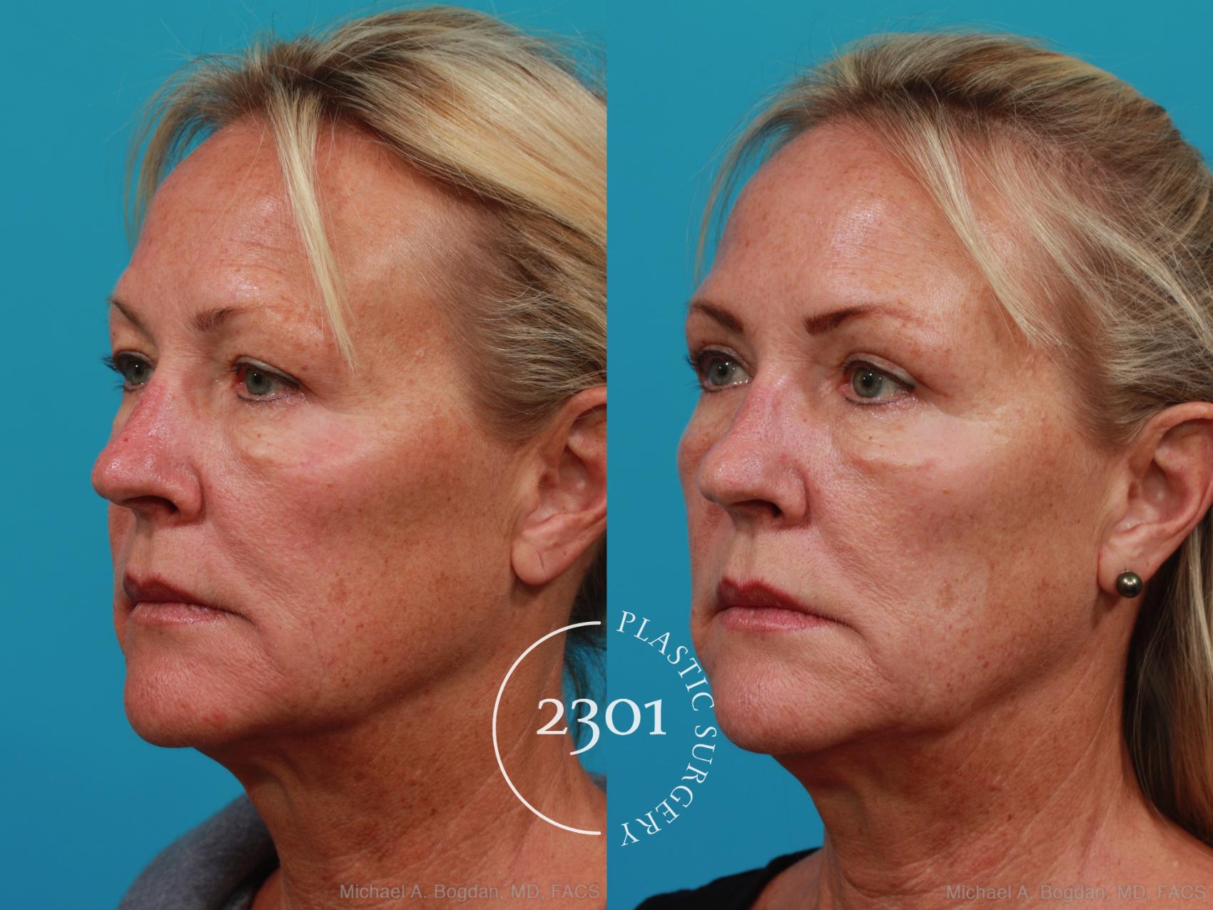Before & After Blepharoplasty Case 290 View #3 View in Fort Worth, Plano, & Frisco, Texas