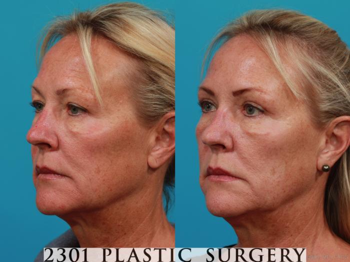 Before & After Blepharoplasty Case 290 View #3 View in Fort Worth, Plano, & Frisco, Texas