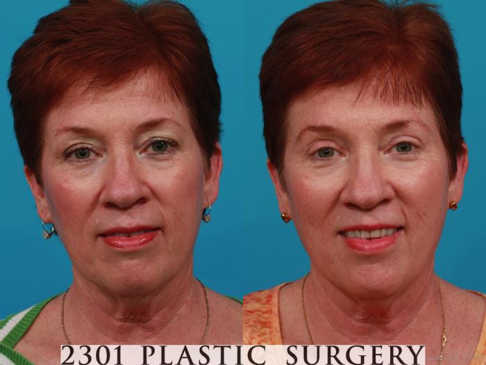 Before & After Blepharoplasty Case 305 View #1 View in Fort Worth, Plano, & Frisco, Texas