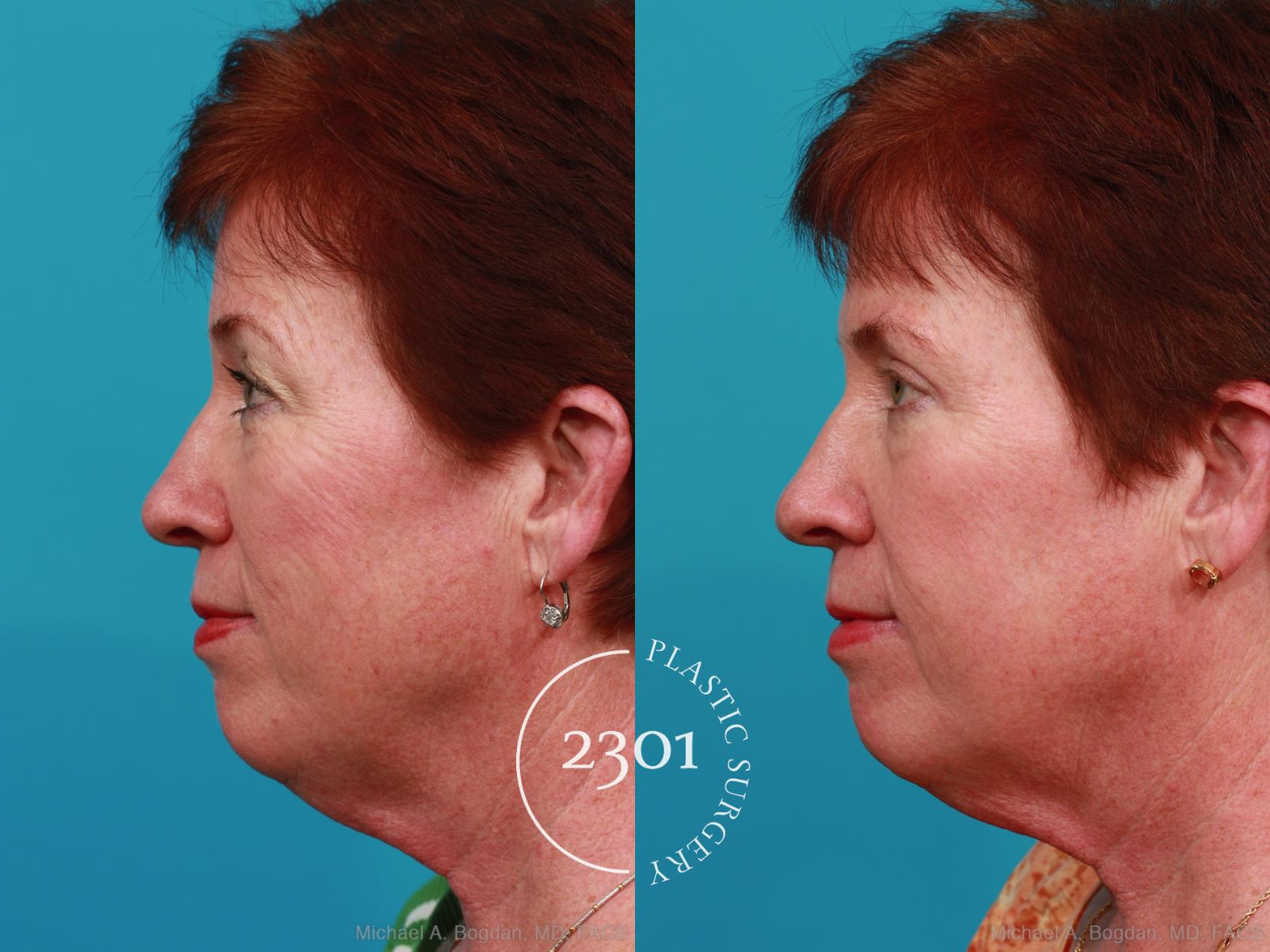 Before & After Blepharoplasty Case 305 View #2 View in Fort Worth, Plano, & Frisco, Texas