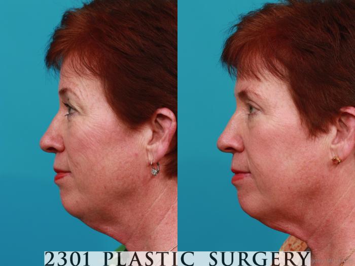 Before & After Blepharoplasty Case 305 View #2 View in Fort Worth, Plano, & Frisco, Texas