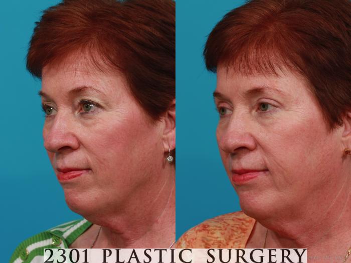 Before & After Blepharoplasty Case 305 View #3 View in Fort Worth, Plano, & Frisco, Texas