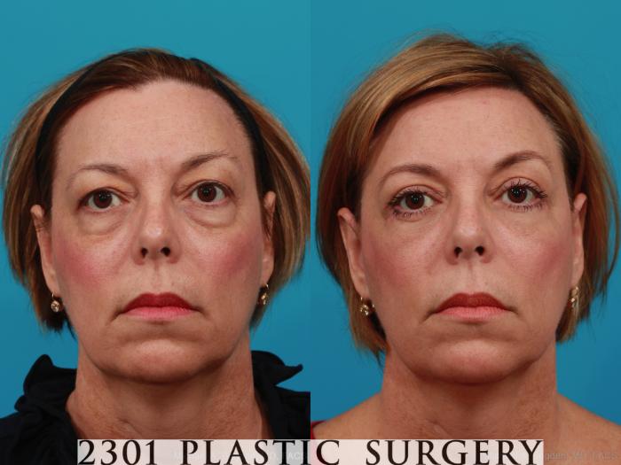 Before & After Blepharoplasty Case 311 View #1 View in Fort Worth, Plano, & Frisco, Texas