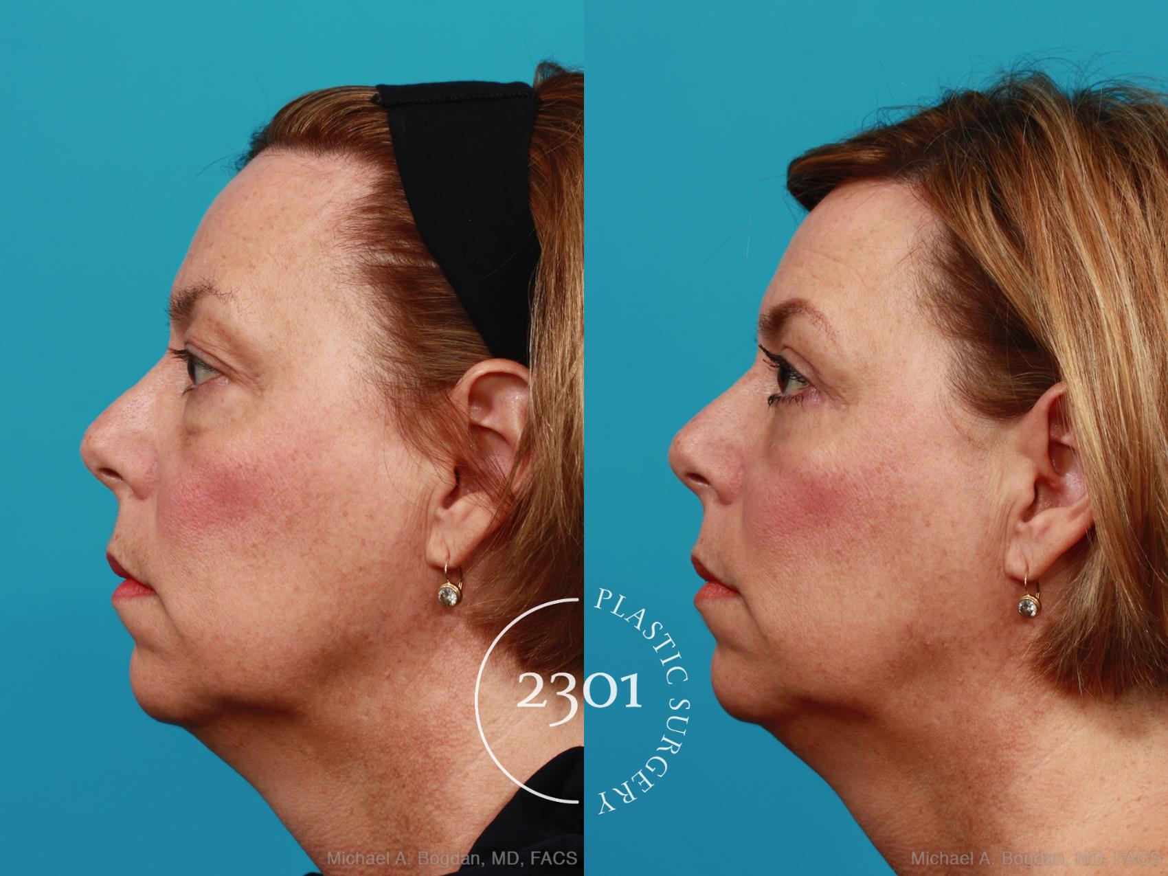 Before & After Blepharoplasty Case 311 View #2 View in Fort Worth, Plano, & Frisco, Texas