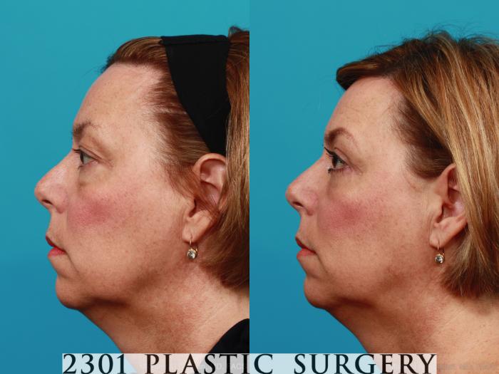 Before & After Blepharoplasty Case 311 View #2 View in Fort Worth, Plano, & Frisco, Texas