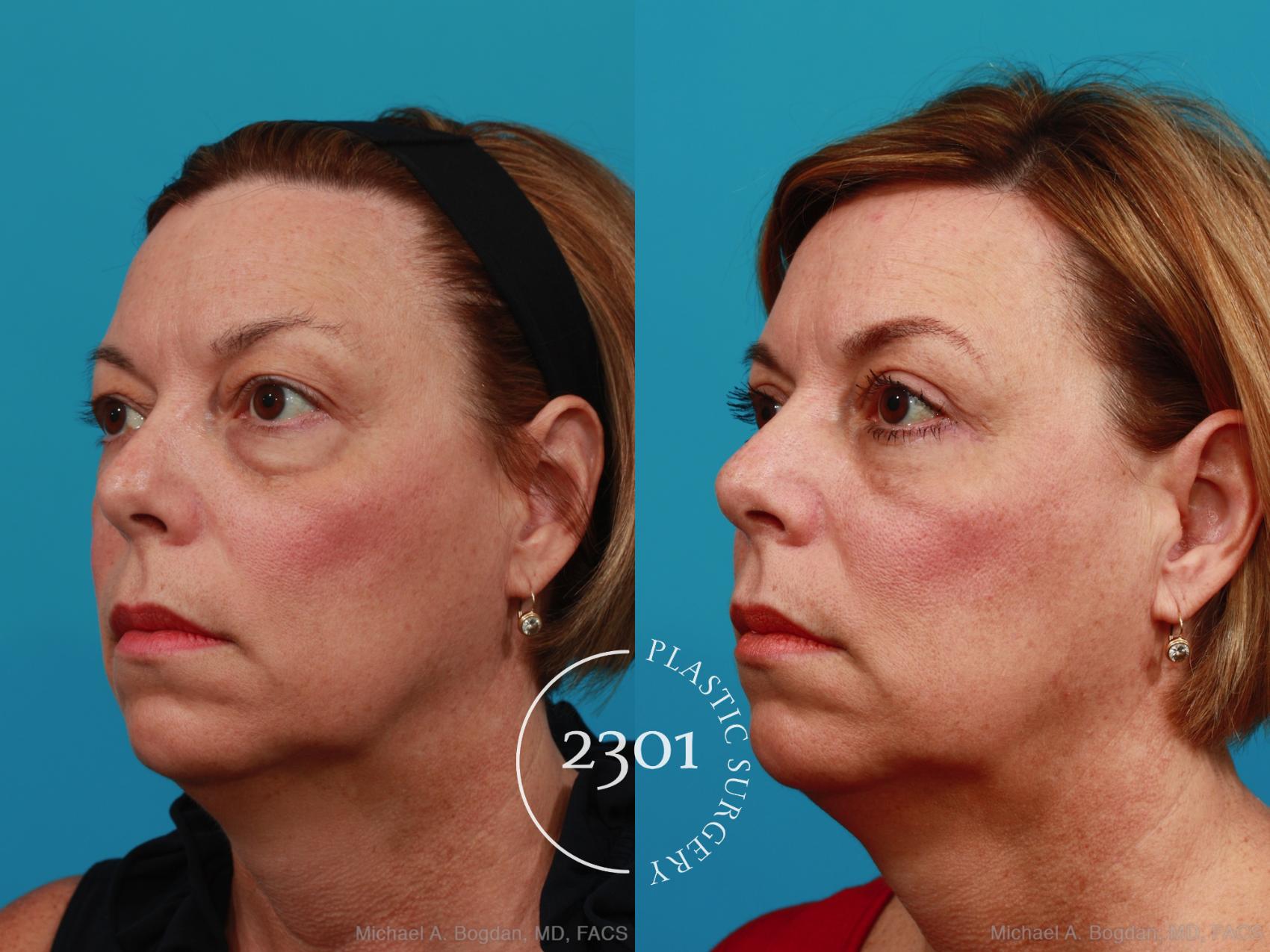 Before & After Blepharoplasty Case 311 View #3 View in Fort Worth, Plano, & Frisco, Texas