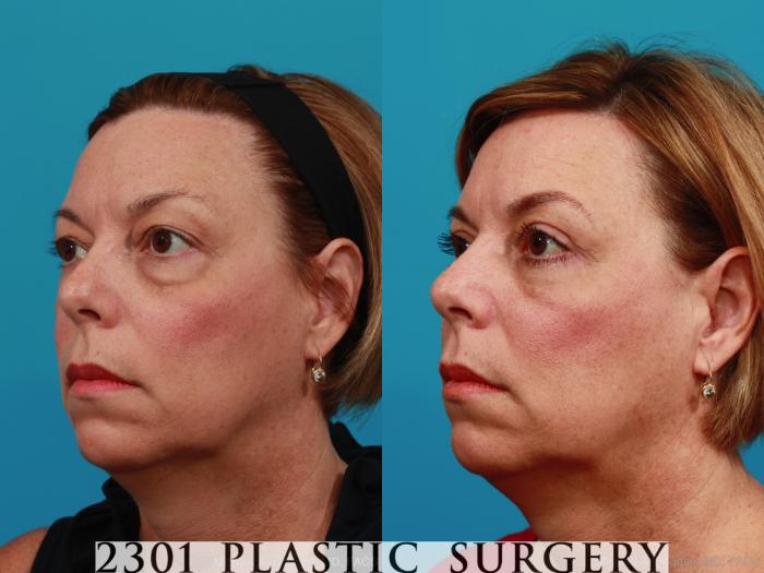 Before & After Blepharoplasty Case 311 View #3 View in Fort Worth, Plano, & Frisco, Texas