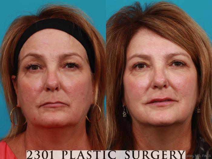 Before & After Blepharoplasty Case 341 View #1 View in Fort Worth, Plano, & Frisco, Texas