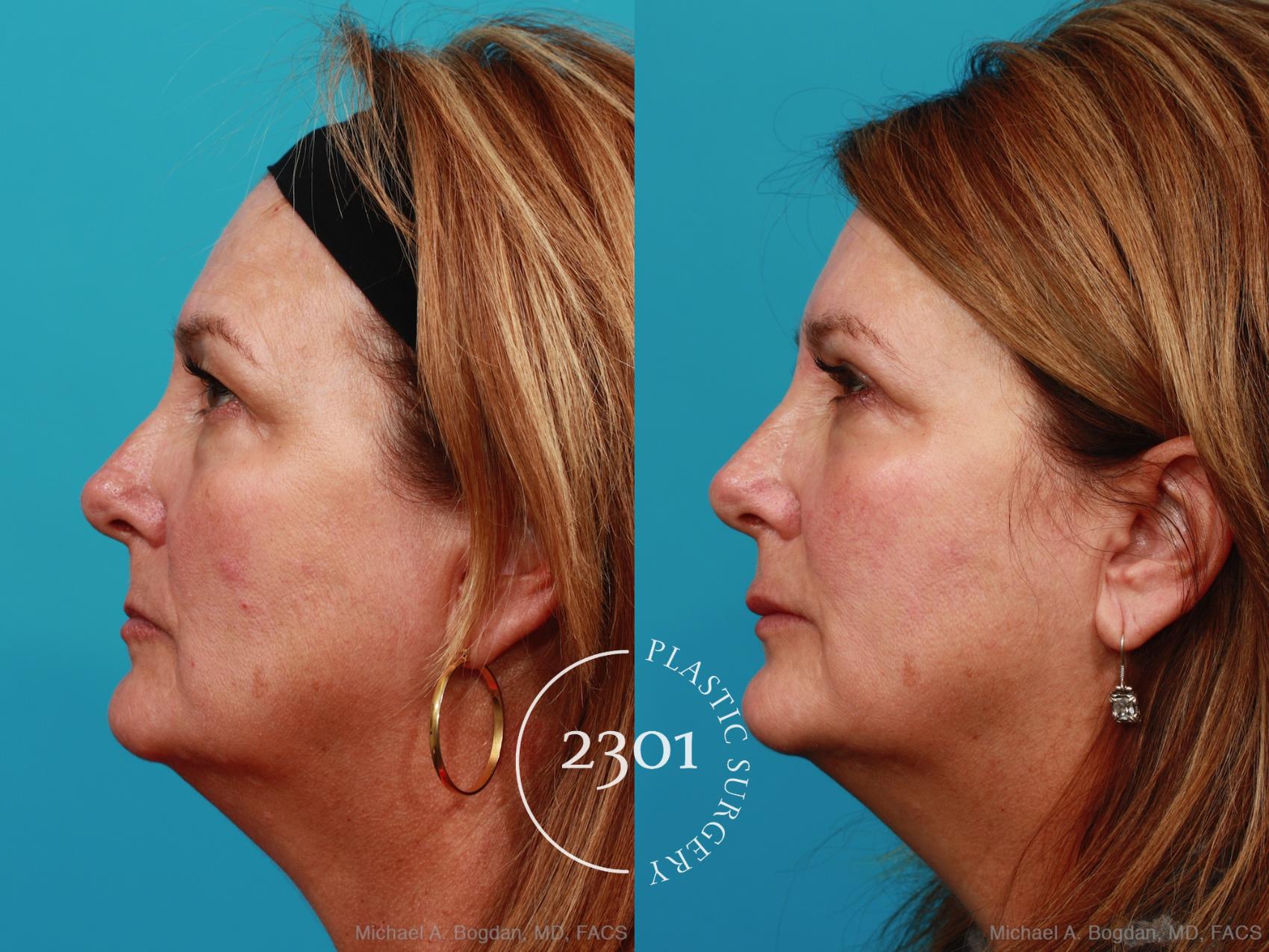 Before & After Blepharoplasty Case 341 View #2 View in Fort Worth, Plano, & Frisco, Texas