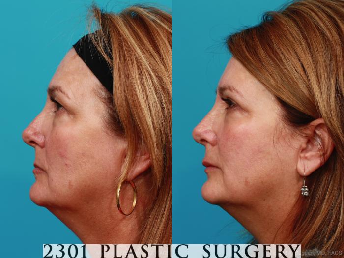 Before & After Blepharoplasty Case 341 View #2 View in Fort Worth, Plano, & Frisco, Texas