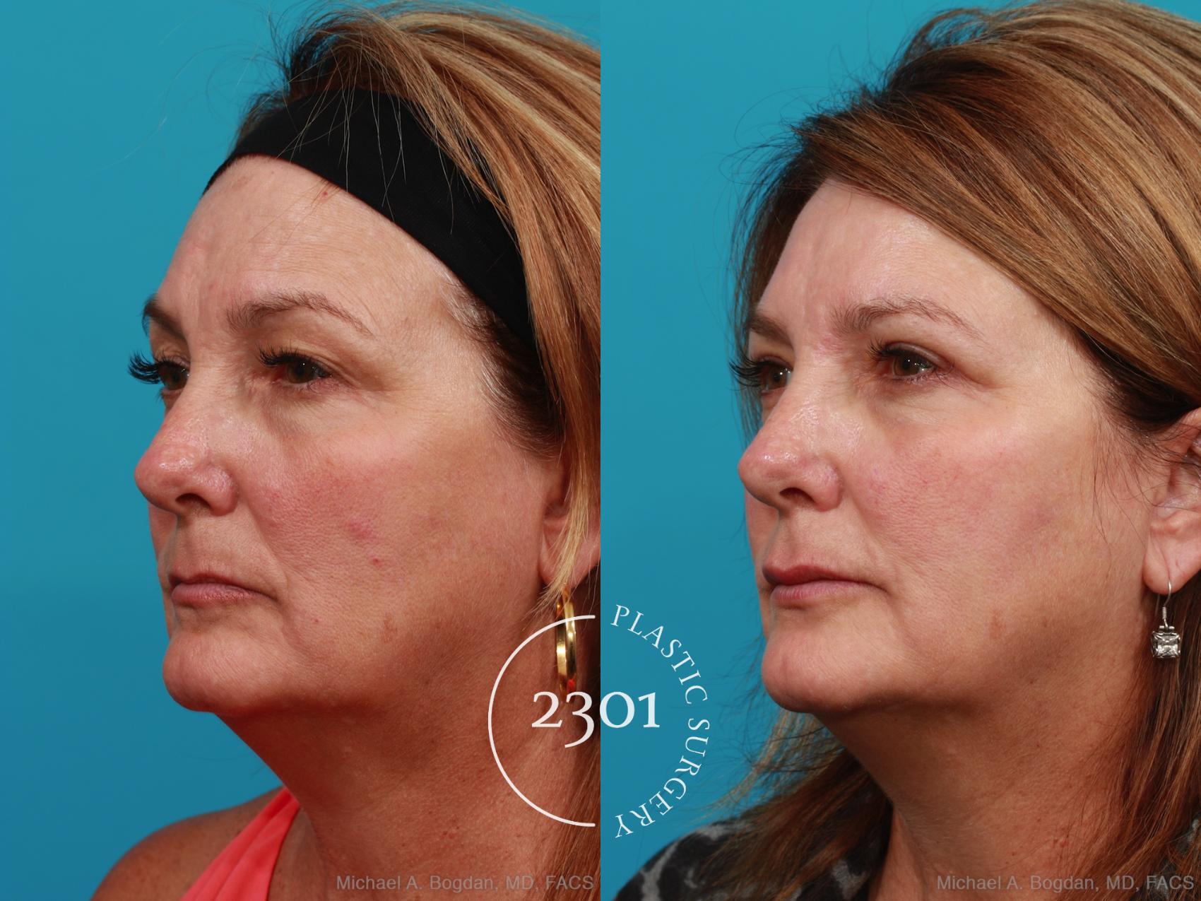 Before & After Blepharoplasty Case 341 View #3 View in Fort Worth, Plano, & Frisco, Texas