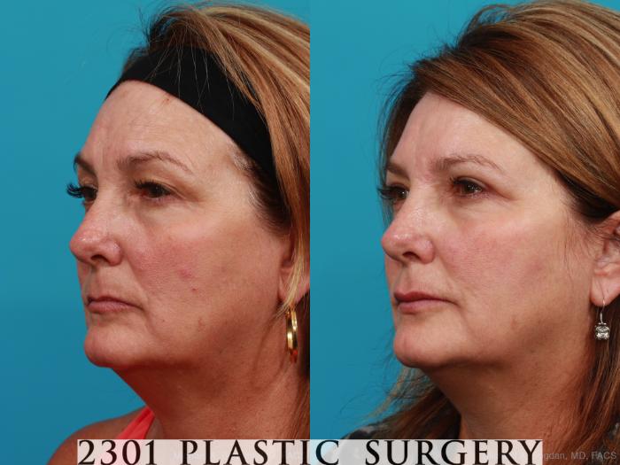 Before & After Blepharoplasty Case 341 View #3 View in Fort Worth, Plano, & Frisco, Texas