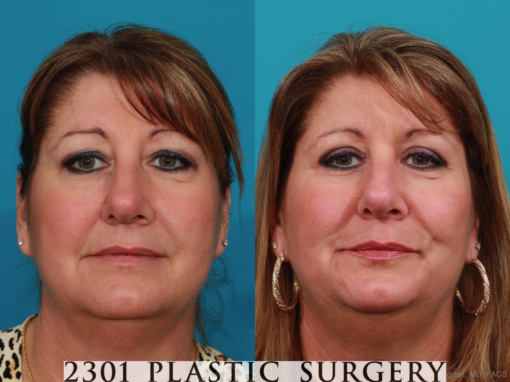 Before & After Blepharoplasty Case 342 View #1 View in Fort Worth, Plano, & Frisco, Texas