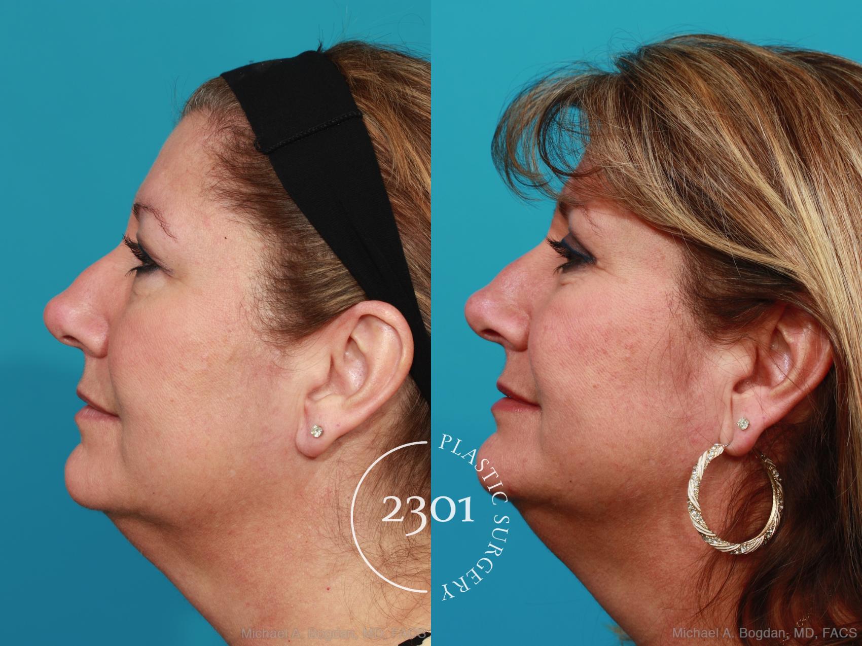 Before & After Blepharoplasty Case 342 View #2 View in Fort Worth, Plano, & Frisco, Texas