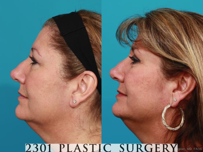 Before & After Blepharoplasty Case 342 View #2 View in Fort Worth, Plano, & Frisco, Texas