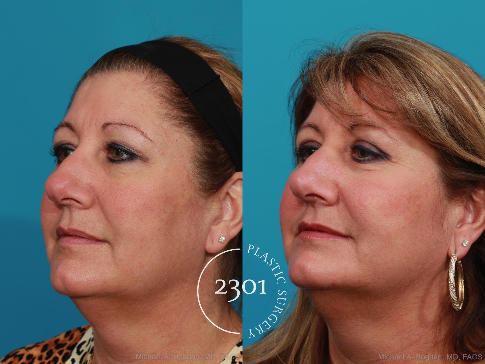 Before & After Blepharoplasty Case 342 View #3 View in Fort Worth, Plano, & Frisco, Texas