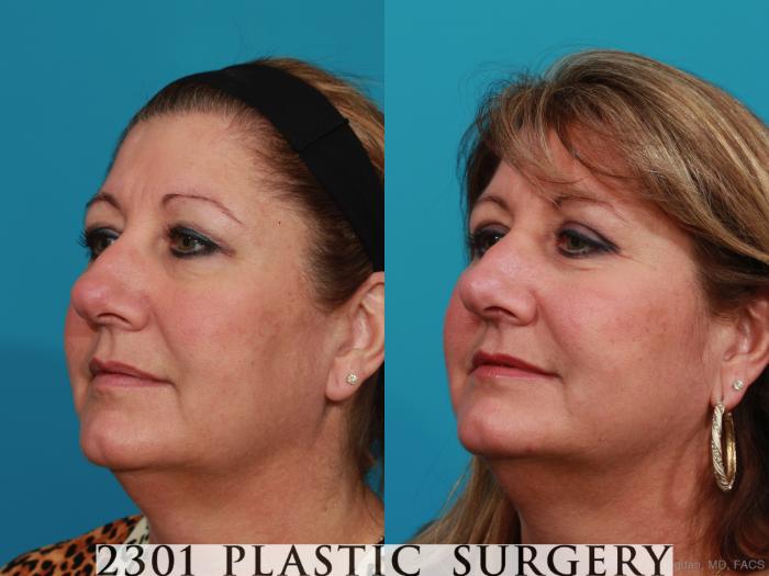 Before & After Blepharoplasty Case 342 View #3 View in Fort Worth, Plano, & Frisco, Texas