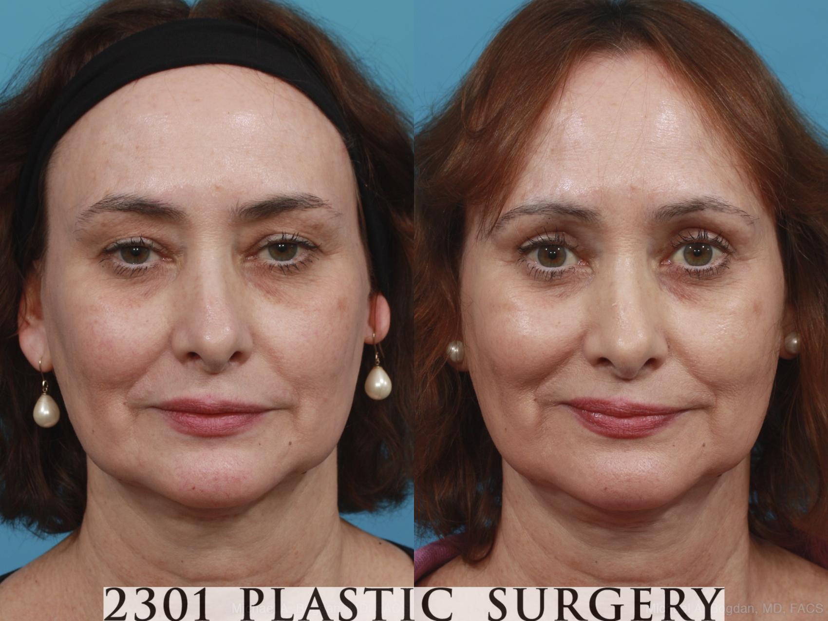 Before & After Blepharoplasty Case 429 View #1 View in Fort Worth, Plano, & Frisco, Texas
