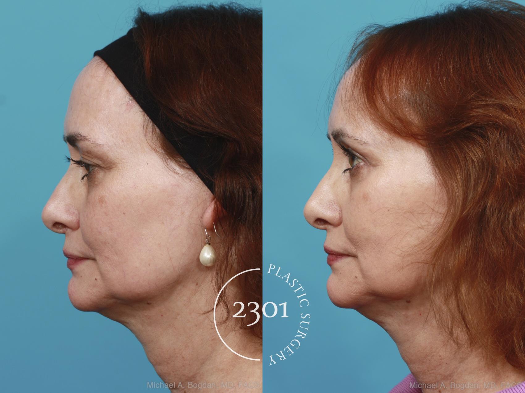 Before & After Blepharoplasty Case 429 View #2 View in Fort Worth, Plano, & Frisco, Texas