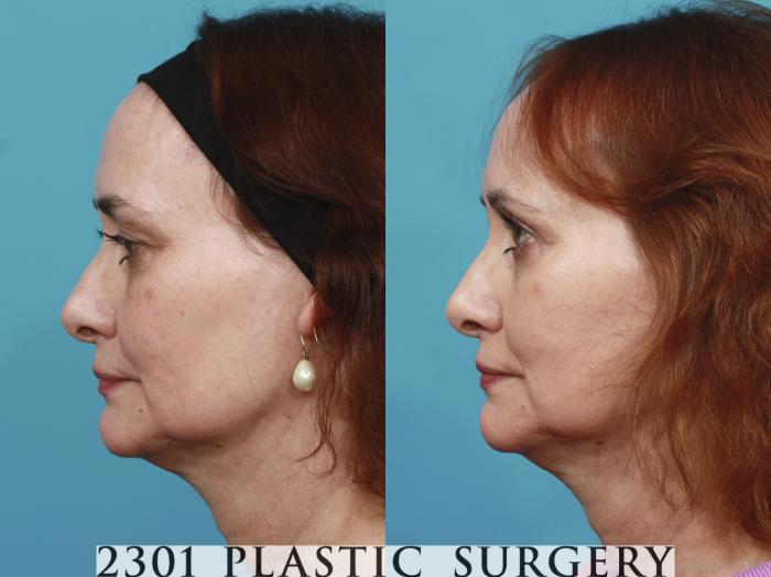Before & After Blepharoplasty Case 429 View #2 View in Fort Worth, Plano, & Frisco, Texas