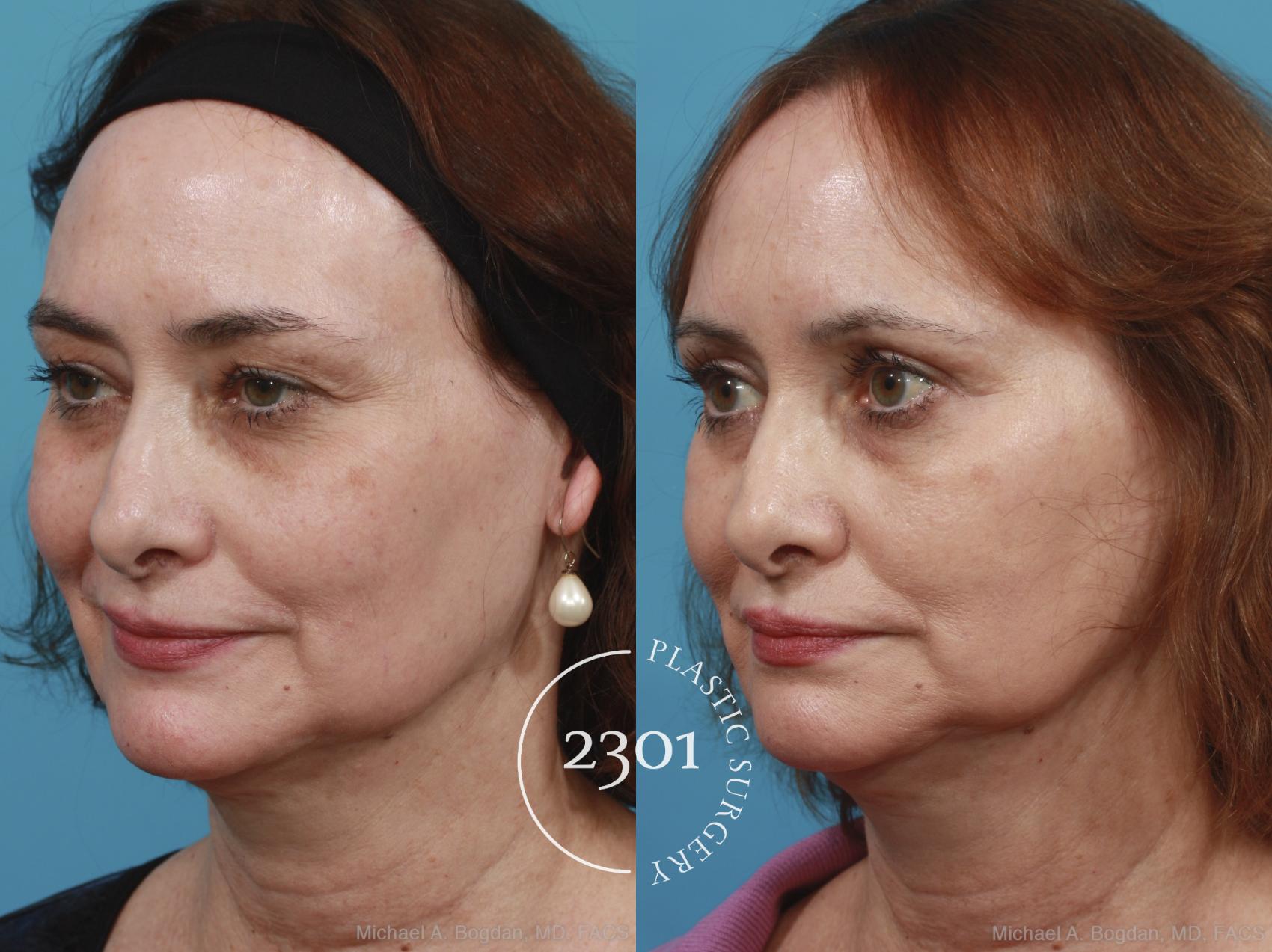 Before & After Blepharoplasty Case 429 View #3 View in Fort Worth, Plano, & Frisco, Texas