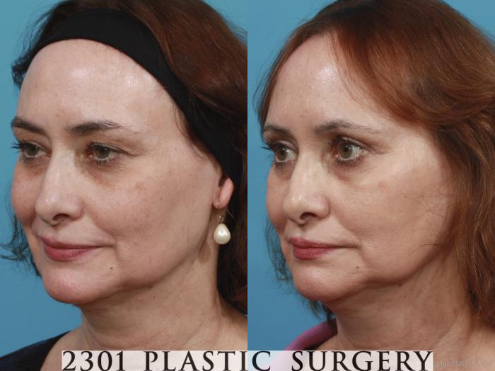 Before & After Blepharoplasty Case 429 View #3 View in Fort Worth, Plano, & Frisco, Texas