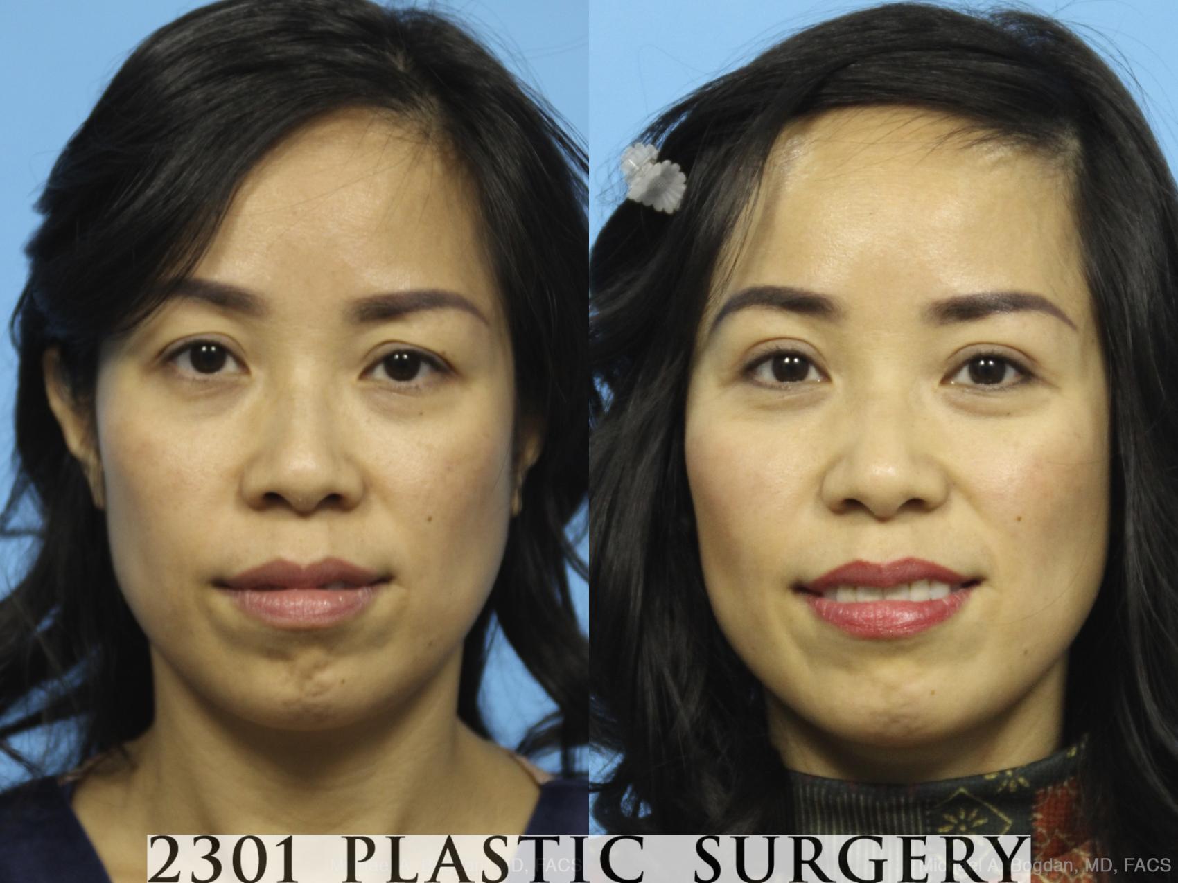 Before & After Blepharoplasty Case 434 View #1 View in Fort Worth, Plano, & Frisco, Texas