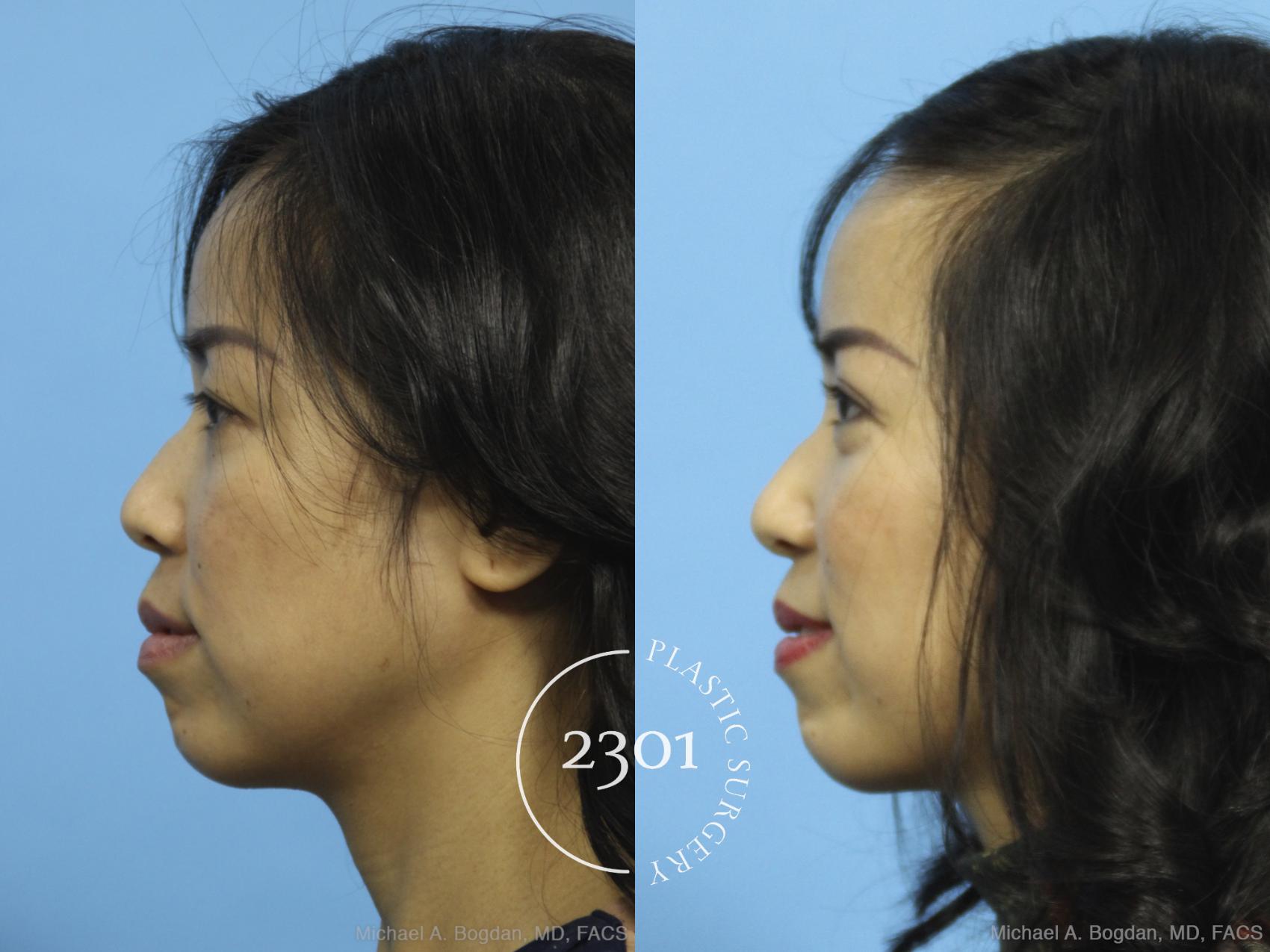 Before & After Blepharoplasty Case 434 View #2 View in Fort Worth, Plano, & Frisco, Texas