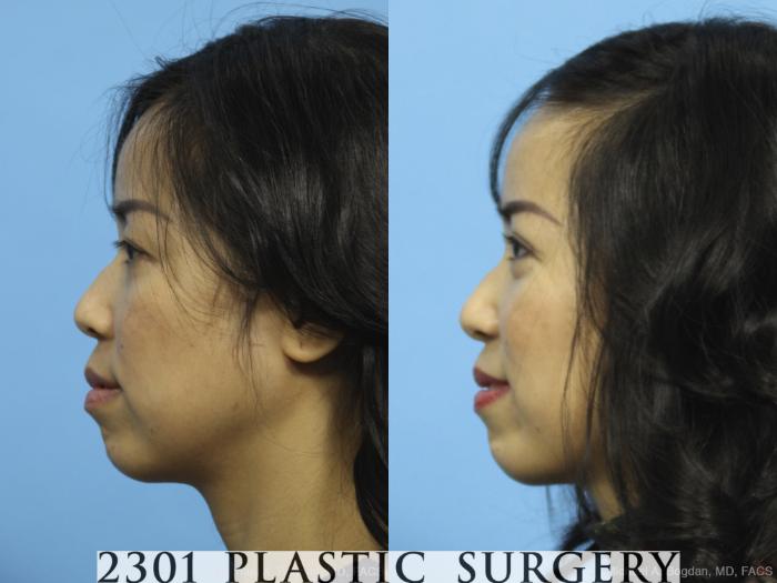 Before & After Blepharoplasty Case 434 View #2 View in Fort Worth, Plano, & Frisco, Texas