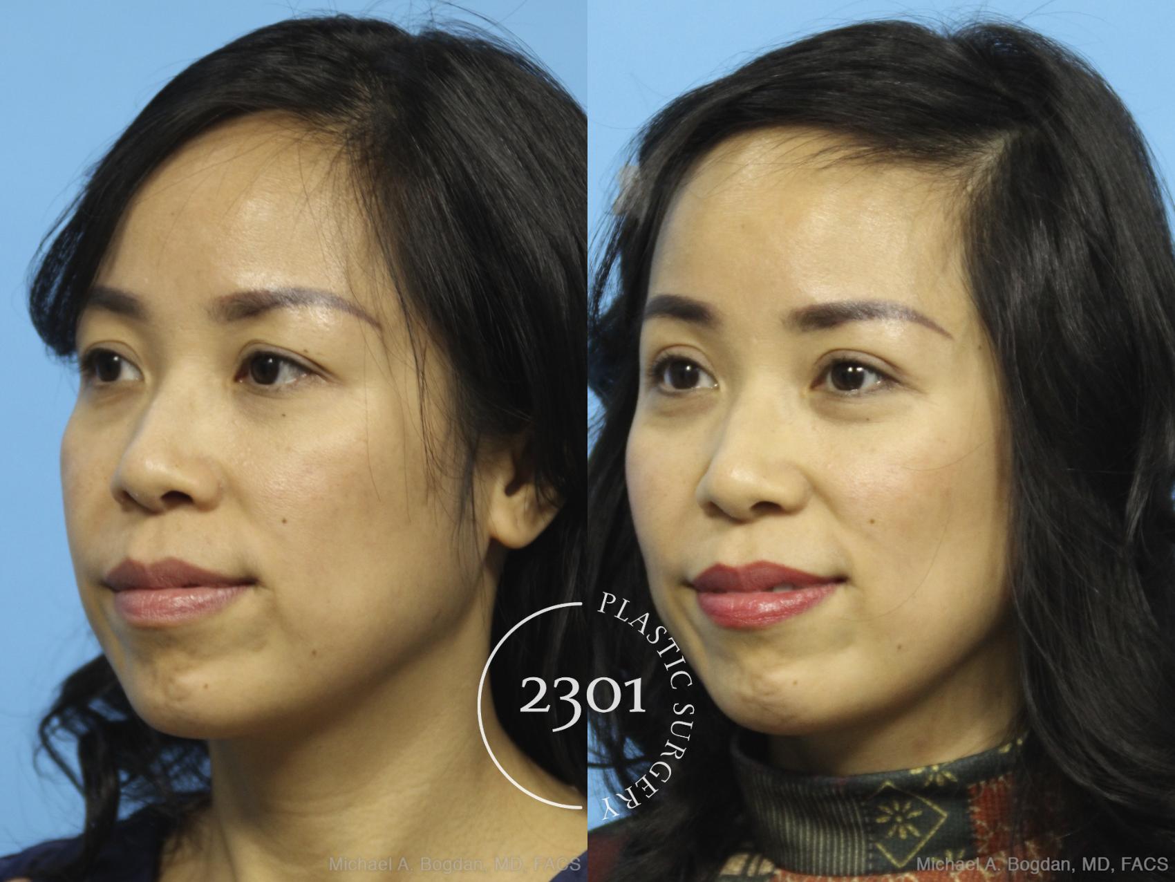 Before & After Blepharoplasty Case 434 View #3 View in Fort Worth, Plano, & Frisco, Texas