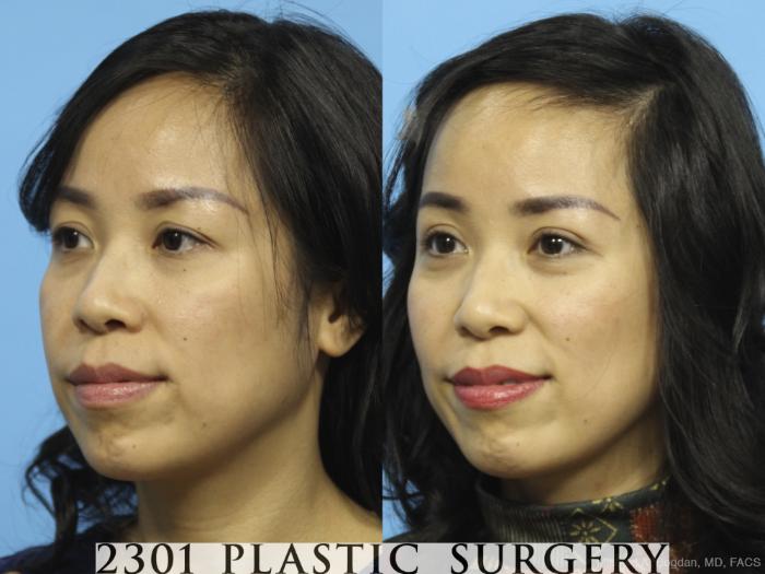 Before & After Blepharoplasty Case 434 View #3 View in Fort Worth, Plano, & Frisco, Texas