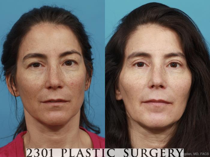 Before & After Blepharoplasty Case 444 View #1 View in Fort Worth, Plano, & Frisco, Texas